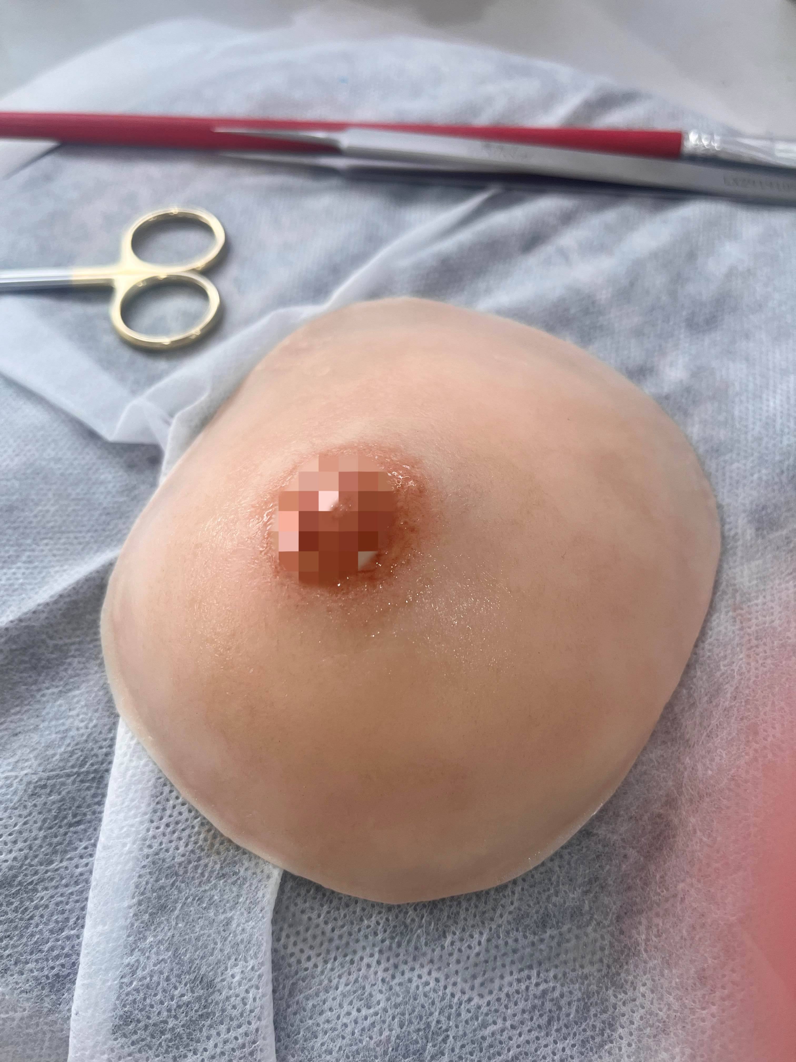breast prosthesis